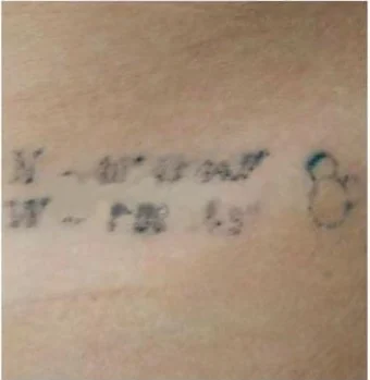 Tatuaje de coordenadas con las letras difuminadas tras 3 sesiones de láser Q-Switched
