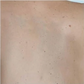 Espalda sin restos visibles del tatuaje de la cruz con alas tras 7 sesiones