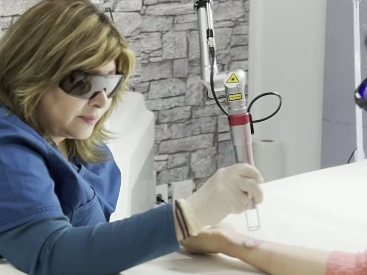 Especialista de Clínica Elimint aplicando láser Q-Switched para eliminar un tatuaje en el brazo de una paciente en Valencia